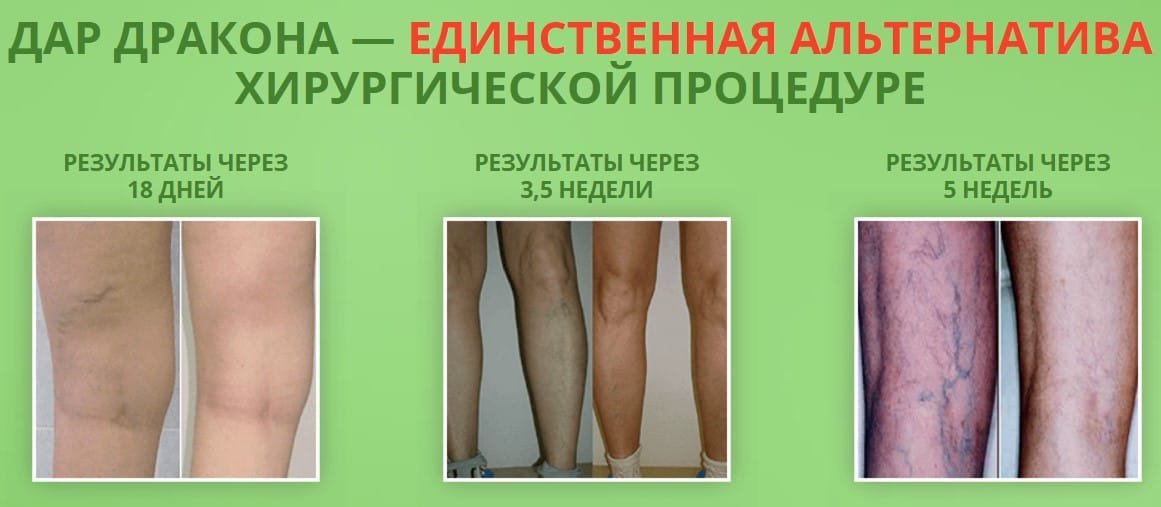 Дар Дракона мазь при варикозном расширении вен