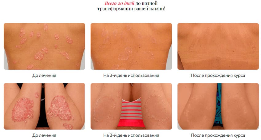 Псори-мазь мазь от псориаза