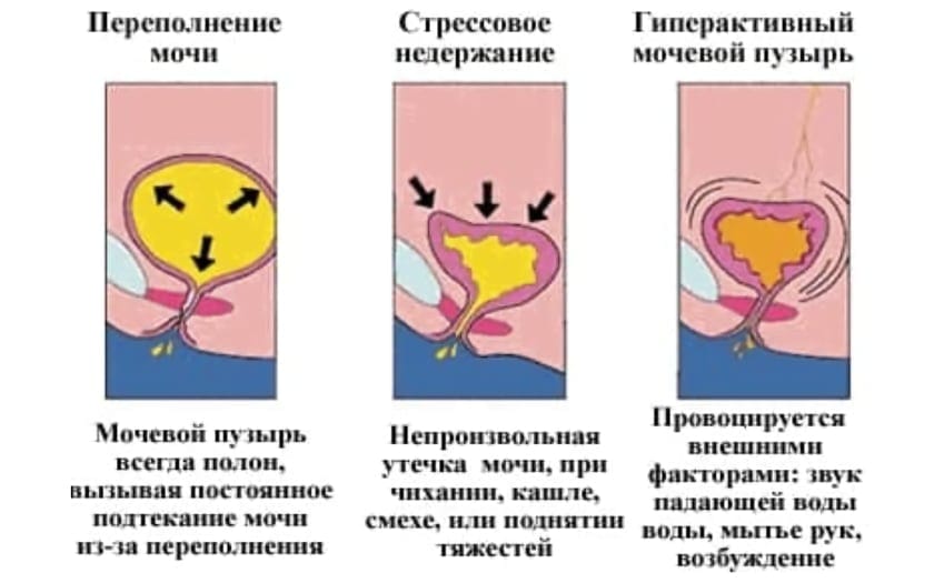 Уронекст порошок при цистите