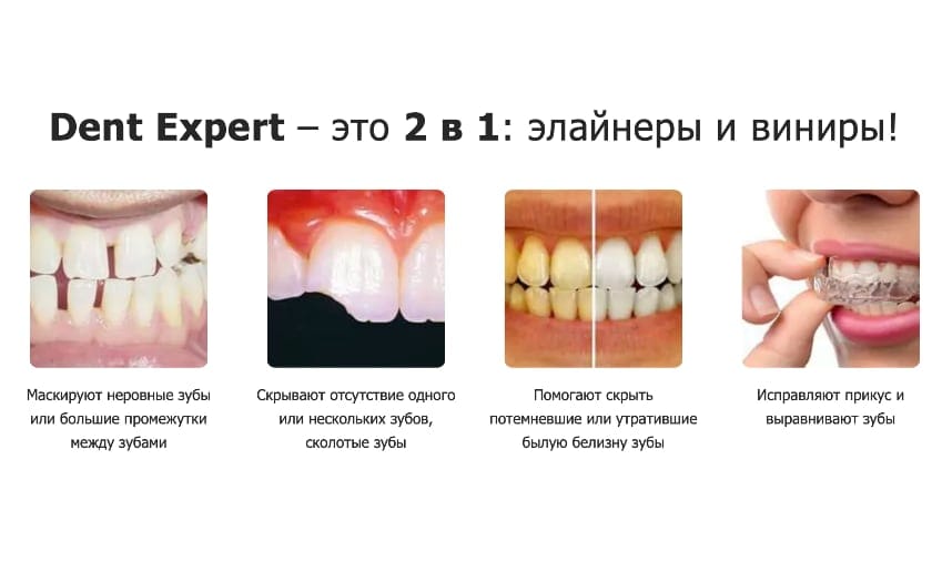 Dent Expert виниры для зубов