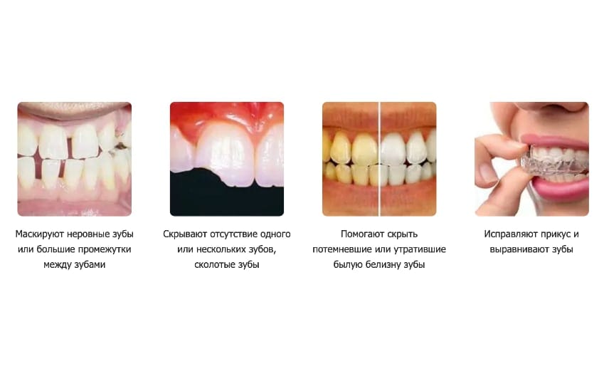 Crystal Veneers виниры для зубов